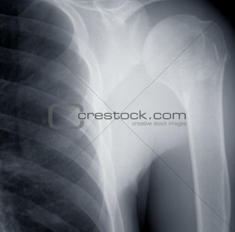 X-ray Shoulder
