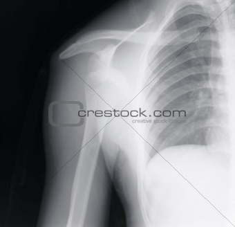 X-ray Shoulder