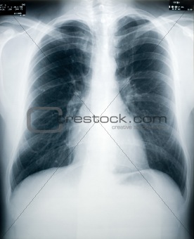 Tuberculosis Screening