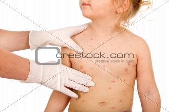 Kid with small pox consulted by a physician - isolated
