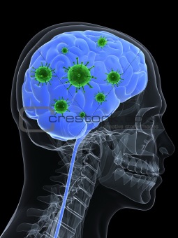 brain infection