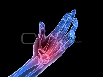 x-ray hand - arthritis