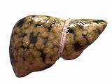fatty liver