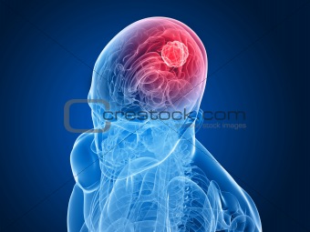 cerebral tumor