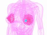 breast cancer illustration