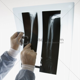Doctor pointing at an x-ray.