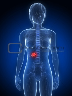 gallbladder cancer