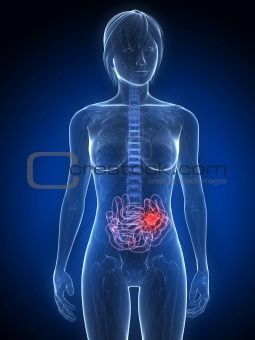 small intestines cancer