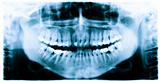 Teeth x-ray image