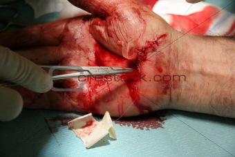 hand surgery 2