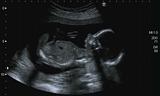 Obstetric Ultrasonography