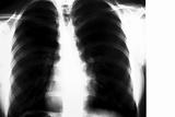 X-ray of the lungs