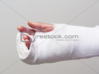 Injured hand in cast and bandage