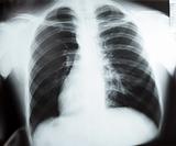 X-ray of chest on previewer