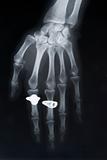 x-ray image of hand with two rings