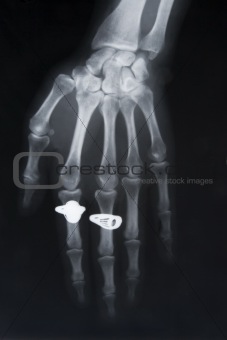 x-ray image of hand with two rings