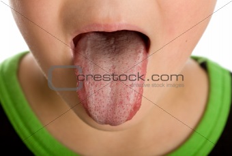 Unhealthy furred or coated tongue