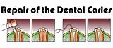 Repair of the Dental Caries