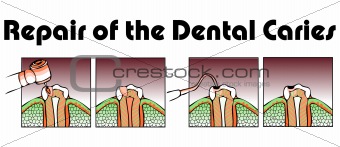 Repair of the Dental Caries