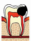 symptoms dental cavity vector illustration