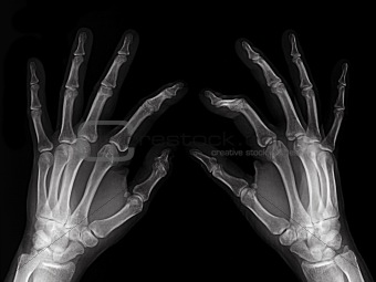 X-rayed hands