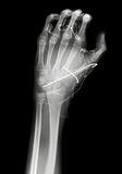 X ray image of hand