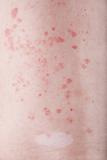 Skin with psoriasis and vitiligo lesion