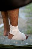 Bandaged foot sitting on hummock outdoors