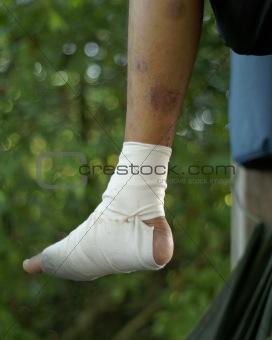 Bandaged foot sitting on hummock outdoors