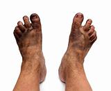 dirty unhygienic feet