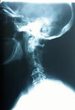 Lateral Cervical Spine