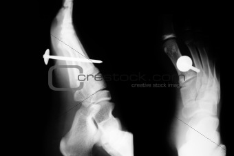 Foot X ray