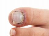 Broken big toe with nail detachment 