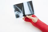 Bandaged Hand And X-Ray Print