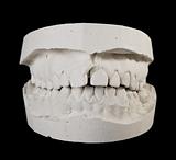 alabaster cast jaws man