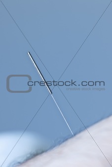 Acupuncture needle in skin