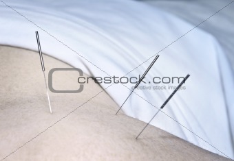 Acupuncture needles in shoulder