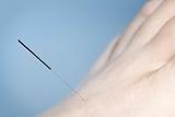Acupuncture needle in foot