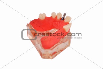 jaw with implant