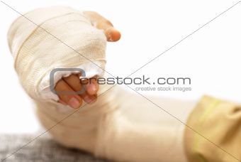 Broken arm