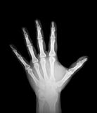 x-ray of human hand