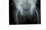 A hip x-ray