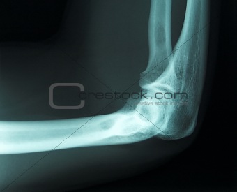 x-ray of a male arm