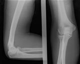 X-ray image of broken elbow