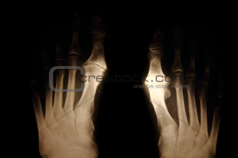 x-ray of foots 