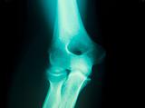 x-ray of a male arm joint