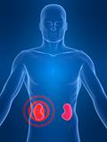 kidney inflammation