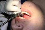 Braces being removed