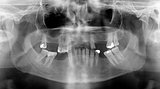 Panoramic dental X-Rays