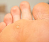 Callus and hyperkeratosis on foot, closeup